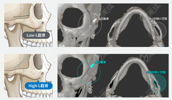 贵州磨脸颊骨手术大概多少钱？价格表在这