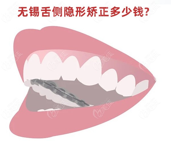 无锡舌侧隐形矫正多少钱
