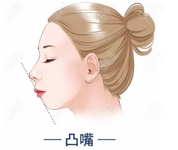 凸嘴怎么自己矯正