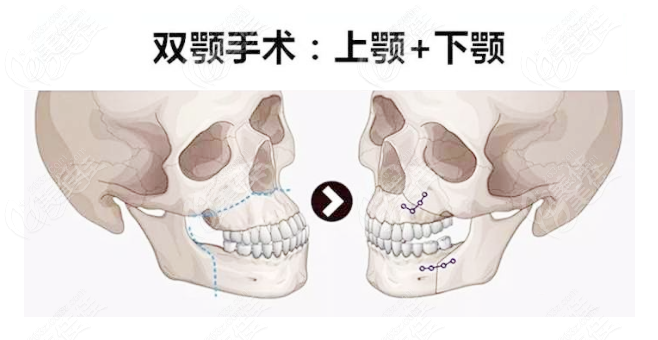 日常如何矯正凸嘴