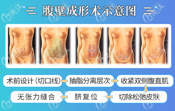 腹壁整形术哪里做得好？腹壁整形术好的医院推荐：广州中家医家庭医生整形医院
