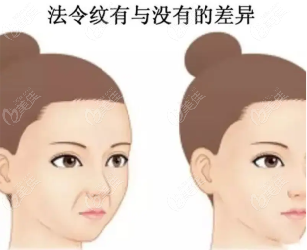运城丽都注射玻尿酸去法令纹后的图片