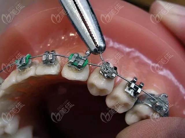 普通金属托槽牙齿矫正器