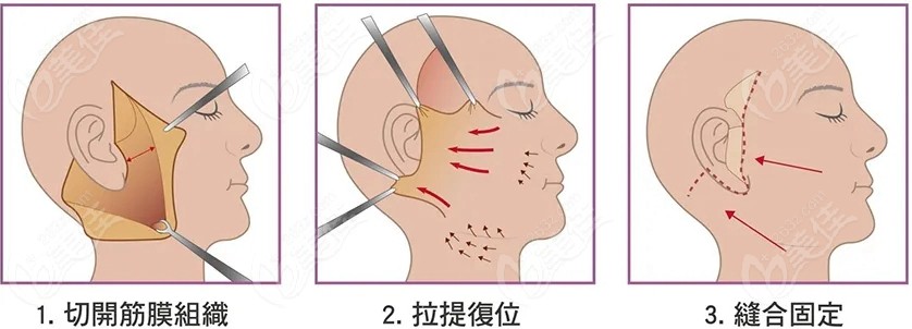 大拉皮手术过程及恢复