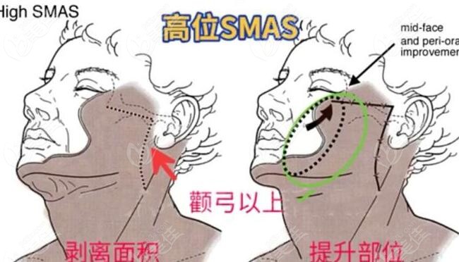 北京大拉皮手术技术特色