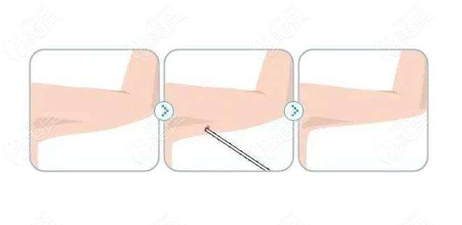 手臂抽脂减肥手术过程图