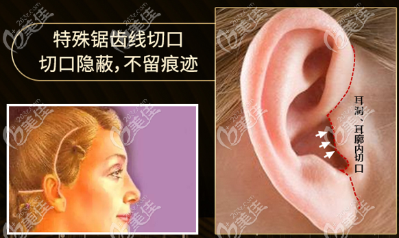 曹孟君小切口拉皮创口小