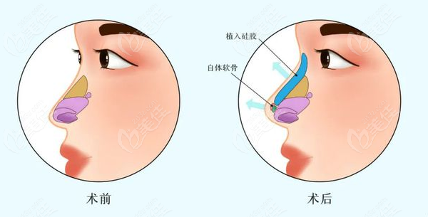 王旭明医生鼻修复前后对比图