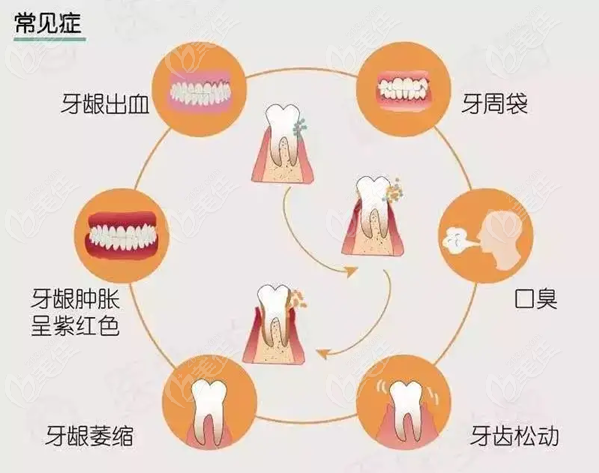 首先,轻度牙周炎一般不需要进行刮治