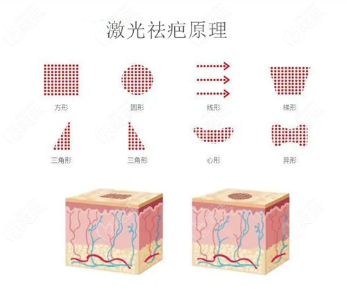 大庆京沪一美整形激光祛疤原理