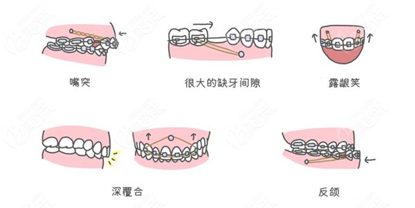 牙齿畸形的表现症状