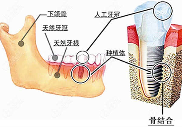 种植牙和原来牙的对比图