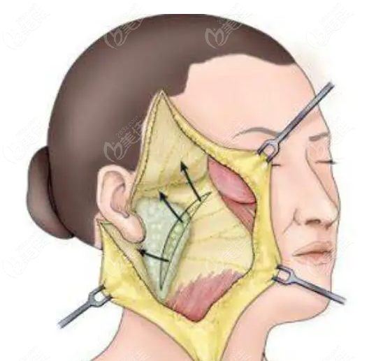 面部大拉皮手术剥离范围大