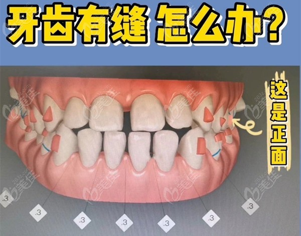 牙齿矫正两三年了牙缝关不上怎么办