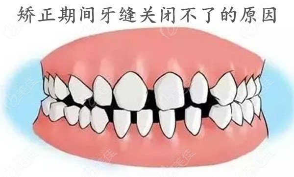 矫正期间牙缝为什么关闭不了