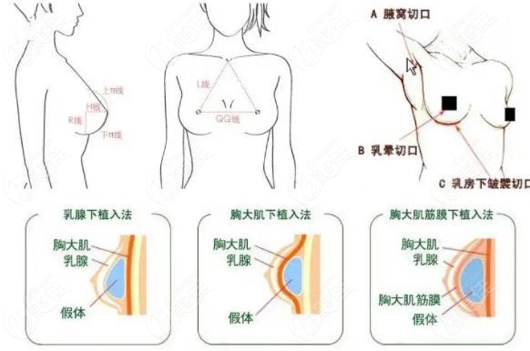 假体隆胸手术三种切口位置图解