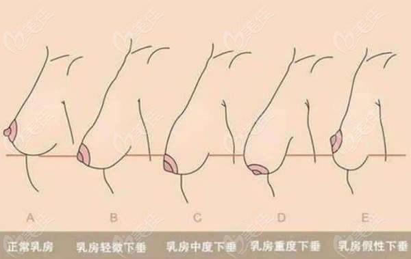 乳房下垂程度等级划分