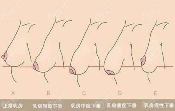 乳房严重干瘪下垂图片图片