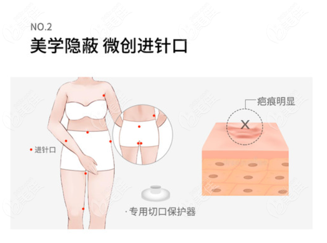 5g天使光雕大腿吸脂傷口在哪m.pfflawyer.com