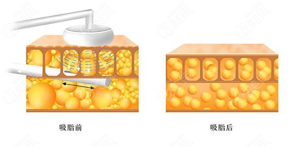 哈爾濱哪個醫院全身吸脂好哈爾濱超龍臻美瑞麗整形抽脂便宜做得好