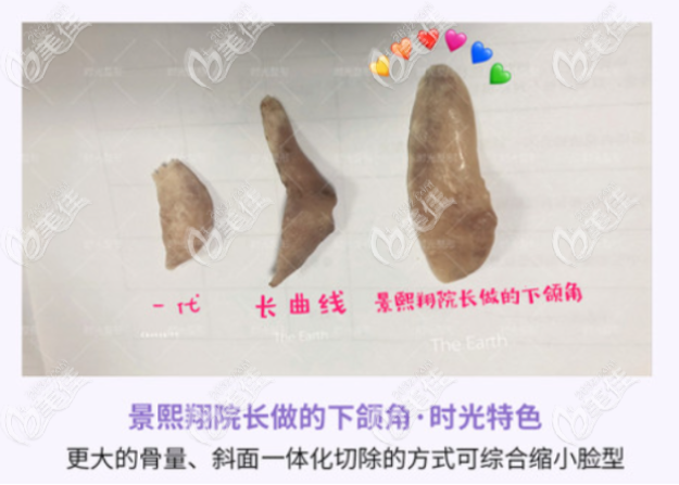 <!--<i data=20240703-sp></i>-->做下颌角手术挺好的 <!--<i data=20240703-sp></i>-->做下颌角手术挺好的