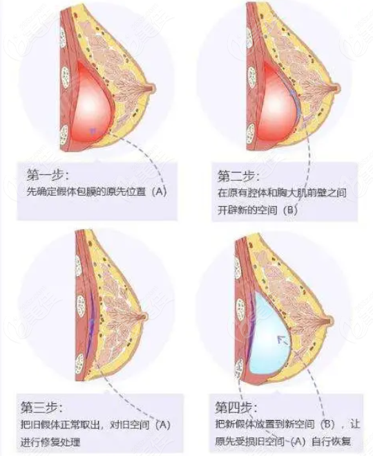 假体隆胸修复的过程