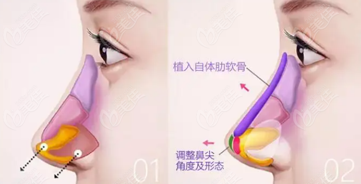 瑆珀超肋做鼻子好吗