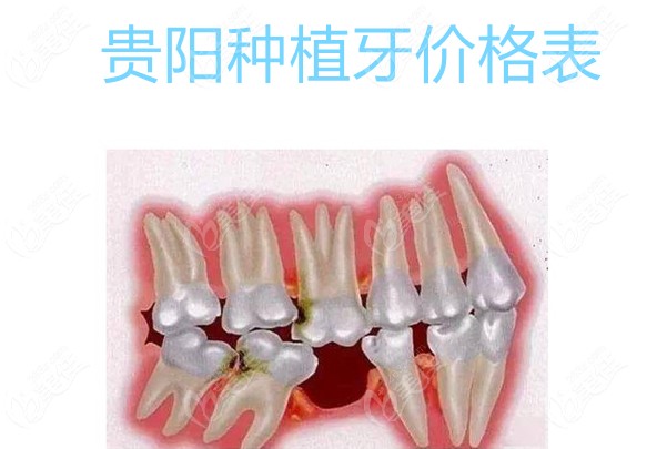 贵阳种植牙价格表