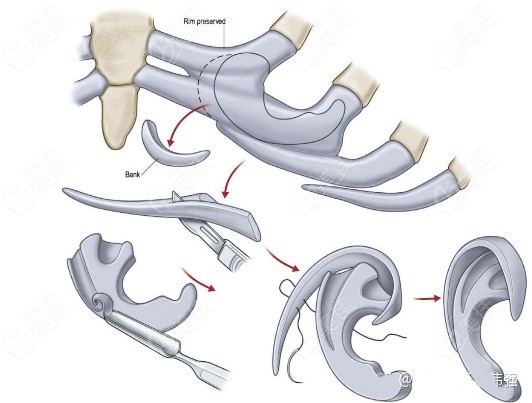 耳再造取肋骨手术示意图