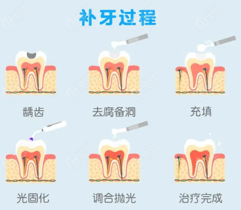 长春补牙洞多少钱一颗