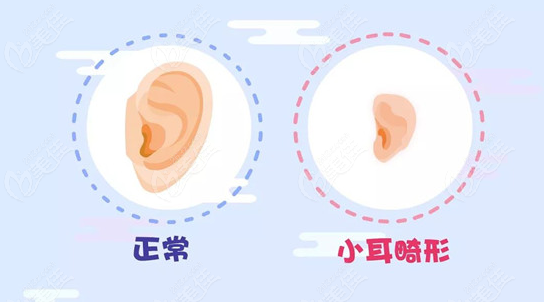 全耳再造手术费用大概需要多少钱