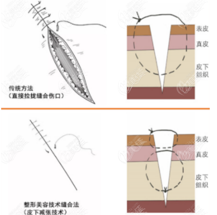白永辉医生修复双眼皮挺好的