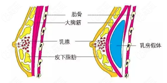 福州台江整形做玉兔动感隆胸技术先进