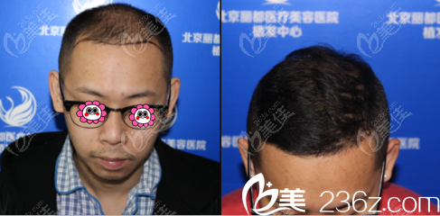 北京丽都马建民头发种植例子