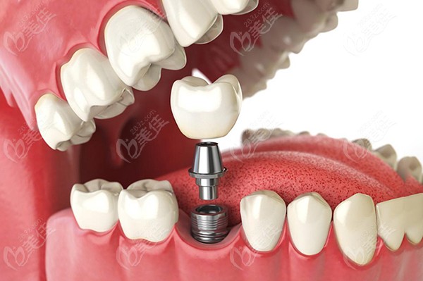 牙博士口腔种植牙的优势