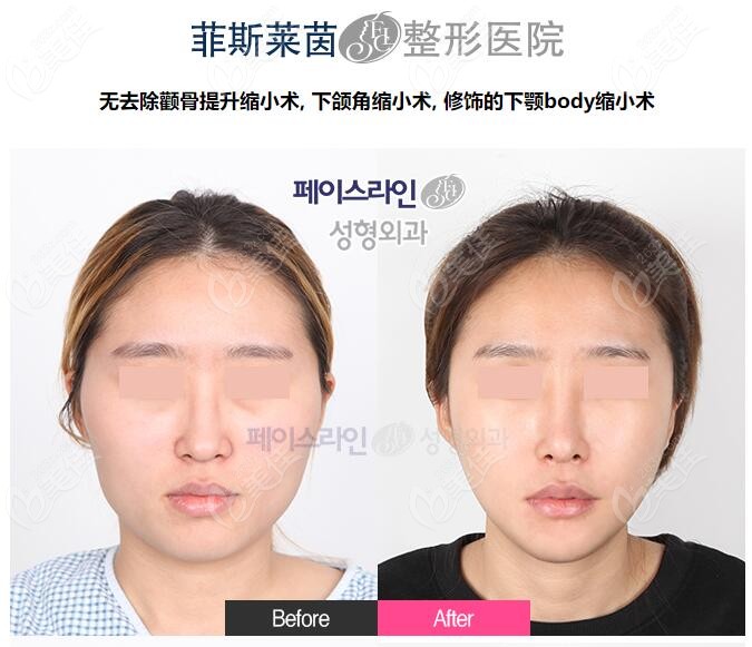 韩国菲斯莱茵改脸型前后对比图
