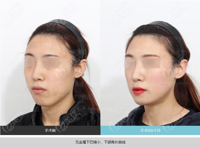 韩国美迪莹整形对比照
