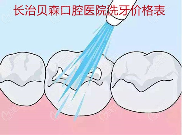 长治贝森口腔医院洗牙的价格表