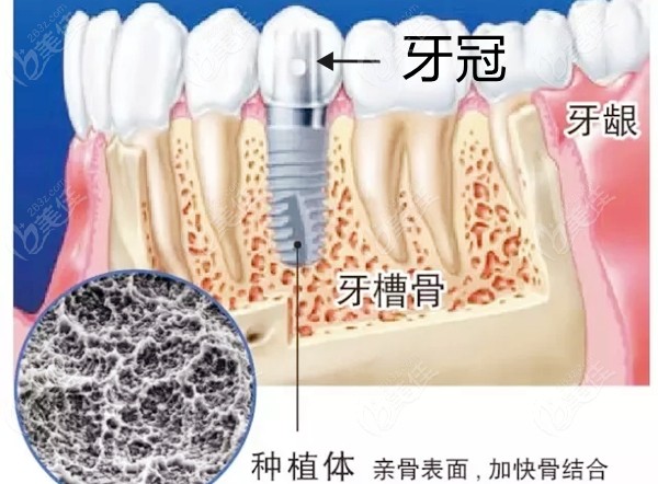 种植体在牙槽骨内的图片