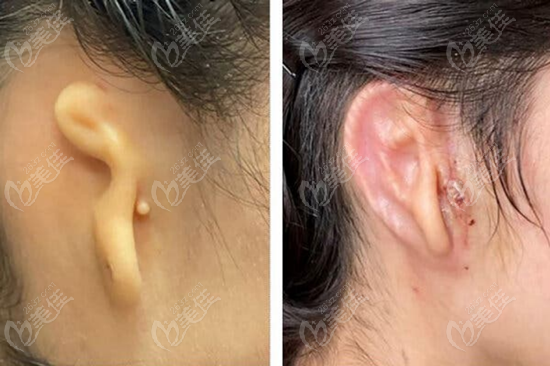 美国3D打印耳朵修复手术前后对比