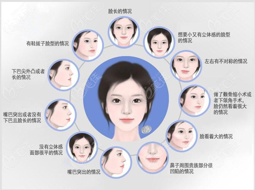 双鄂手术可以改善的脸型