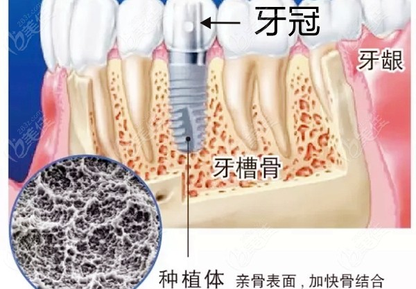 牙根在牙槽骨内的图片
