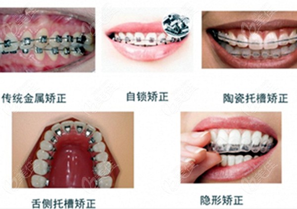牙齿矫正器的各自类型