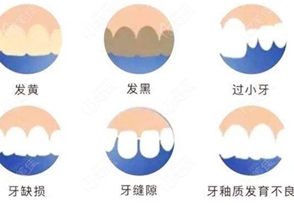 牙齿贴面的适应症