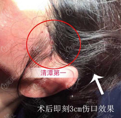 韩国清潭第 一拉皮术后疤痕图片