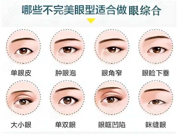 上海美莱科普哪些眼睛适合做眼综合
