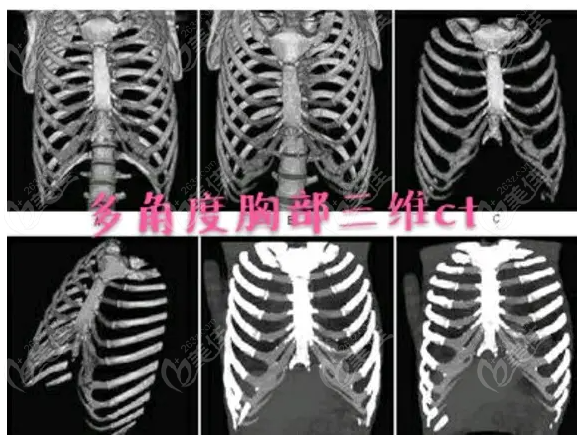 肋软骨三维CT检查
