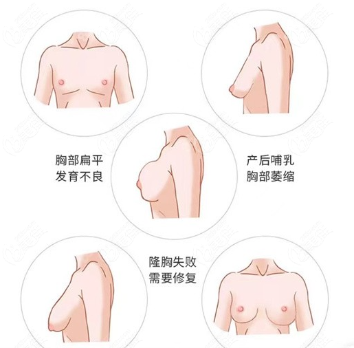 成都华美紫馨宋晓东医生做假体隆胸怎么样