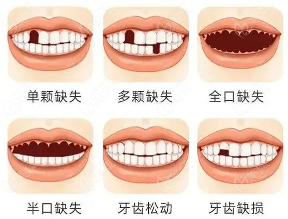 团圆口腔种植牙价格表