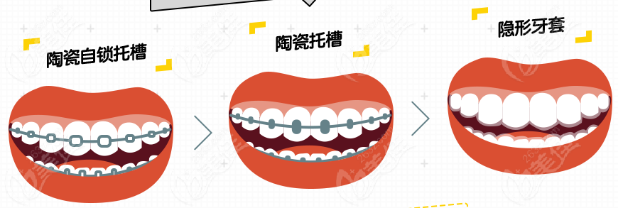 南京鼓楼区口腔医院正畸费用与牙套有关